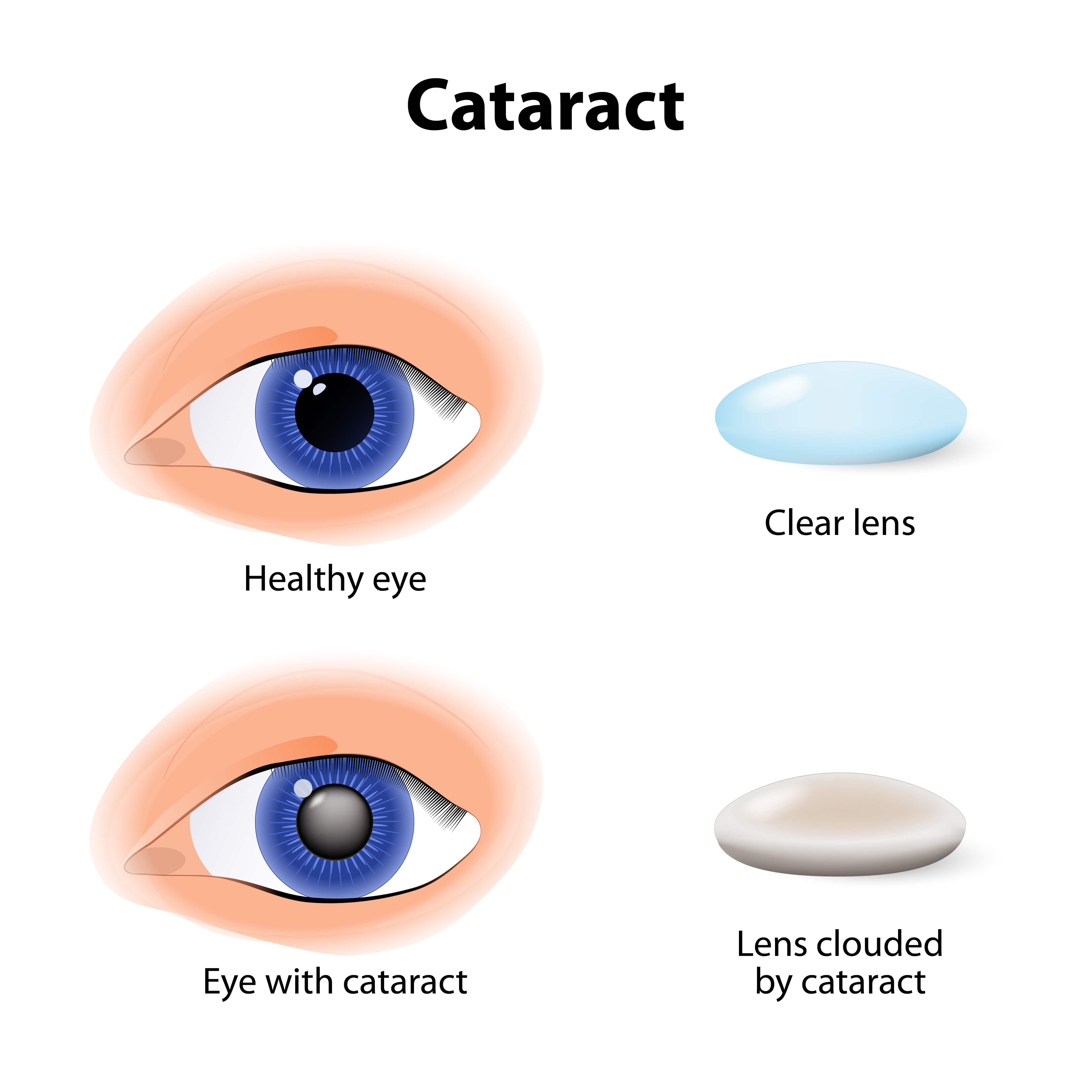 Image shows to eye illustrations. One eye has a clear lens with no cataract and the other eye has a cloudy lens with cataract.