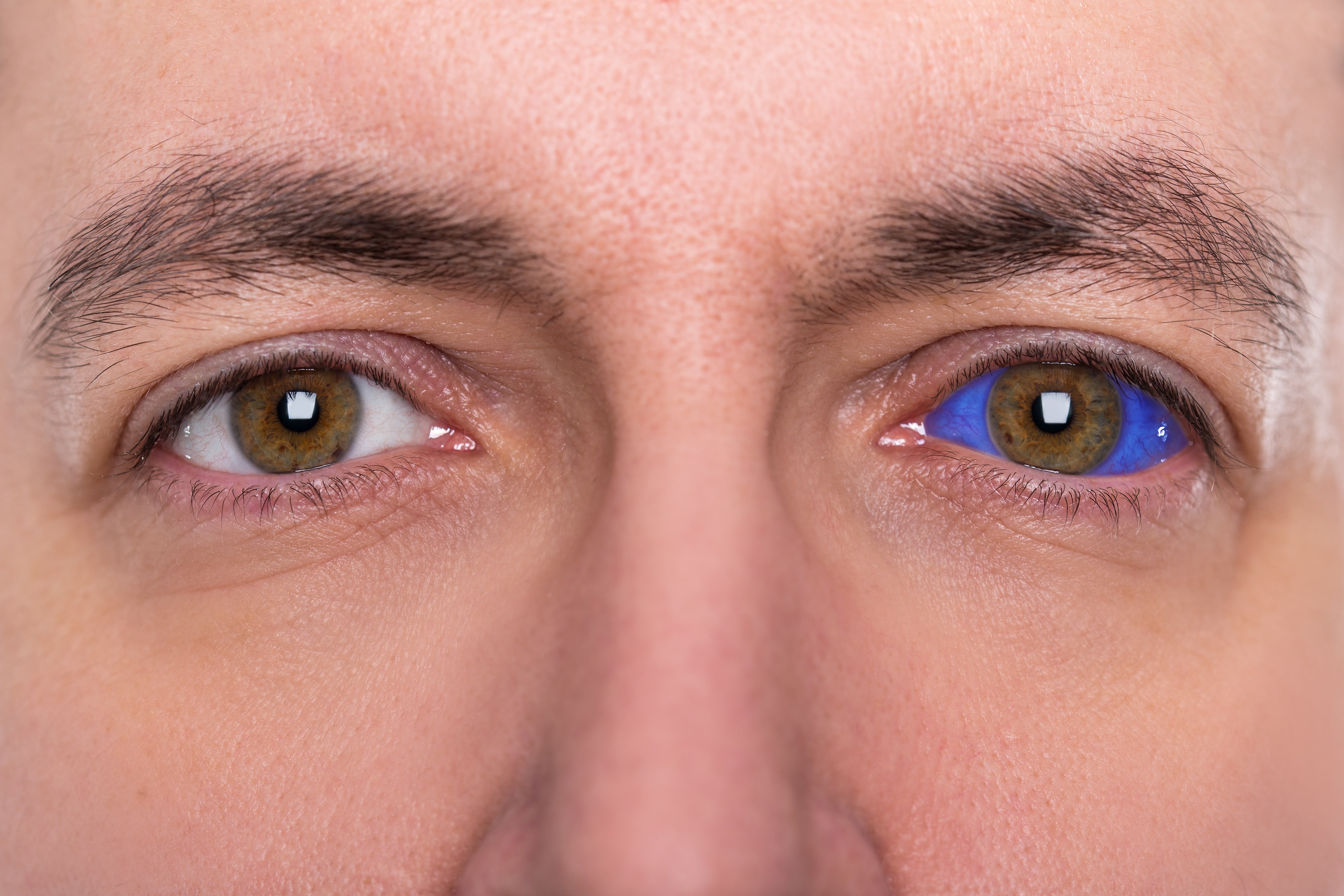 Image showing a closeup of a man with one normal eye and one eye with a blue sclera tattoo